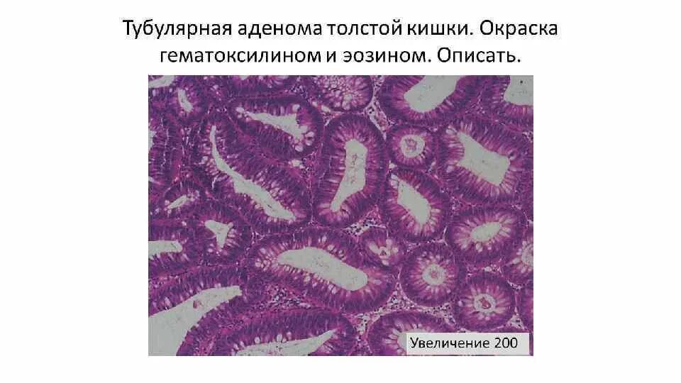 Тубулярная аденома толстой кишки гистология. Тубуло-ворсинчатая аденома толстой кишки гистология. Тубулярно-ворсинчатая аденома толстой кишки гистология. Тубуло-ворсинчатая аденома толстой кишки препараты. Тубулярная аденома толстой кишки что