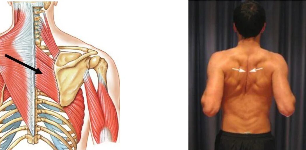 Защемление лопаточной мышцы. Ромбовидная мышца. Растяжка ромбовидной мышцы. Трапециевидная и ромбовидная мышца спины.