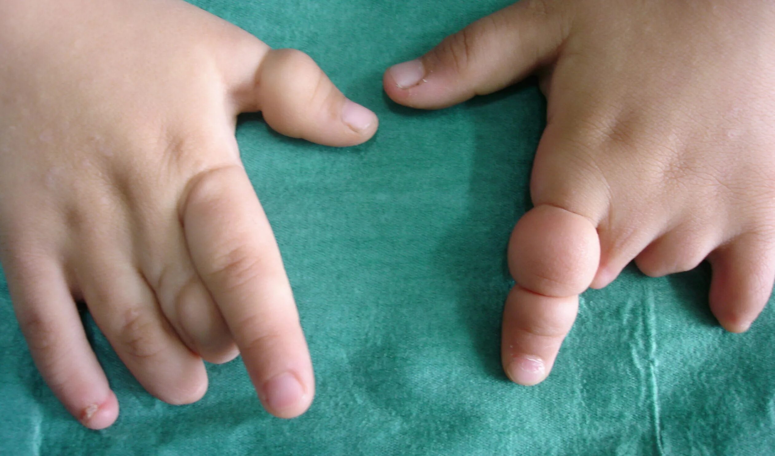 Имеет два развитых пальца. Брахидактилия синдактилия. Синдром амниотических перетяжек. Синдром амниотических нитей.