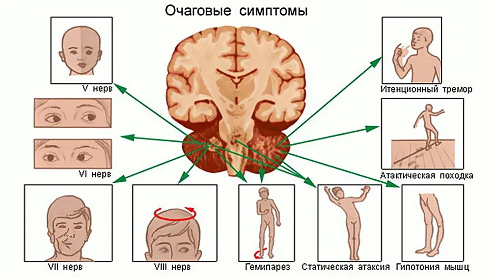 Рак мозга степени. Очаговая неврологическая симптоматика менингит. Симптомы мозжечковой опухоли. Синдромы при опухолях головного мозга. Клинические симптомы поражения мозжечка.