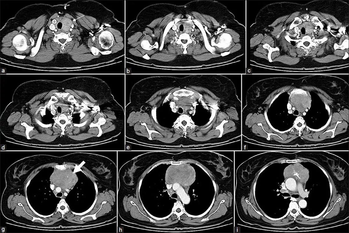 Магниторезонансная томография (мрт). Кт средостения норма. Кт снимок грудной клетки. Снимки компьютерной томографии грудной клетки. Патологическое пространство