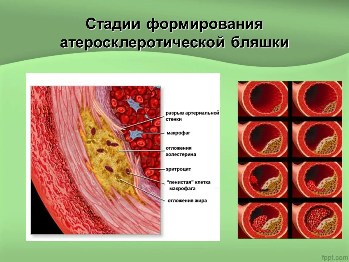 Степени атеросклероза венечных артерий. Этапы развития атеросклеротической бляшки. Этапы формирования атеросклеротической бляшки. Атеросклероз строение бляшки.