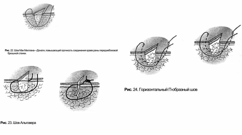 Х образный шов. Вертикальный матрацный шов по Альговеру. Шов по Донати и Альговеру. Узловой шов п-образный вертикальный (Донати). П образный шов по Альговеру.