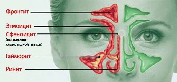 Гайморит фронтит синусит этмоидит. Сфеноидит воспаление клиновидной пазухи. Что такое этмоидит в носовой пазухе ?.