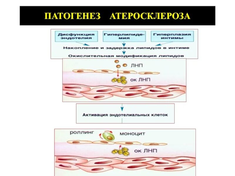 Атеросклероз возраст. Патогенез атеросклероза. патогенез атеросклеротической бляшки. механизм развития атеросклероза. этиология атеросклероза.