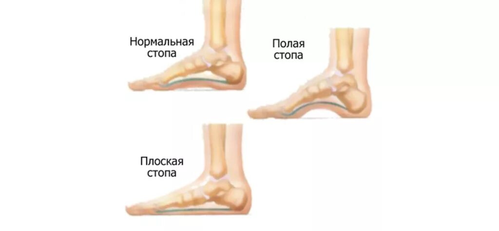 Подъем стопы. Высокий свод стопы у ребенка. Полая плоская нормальная стопа. Высокий подъем стопы и плоскостопие. Плоскостопия на высоком своде стопы.