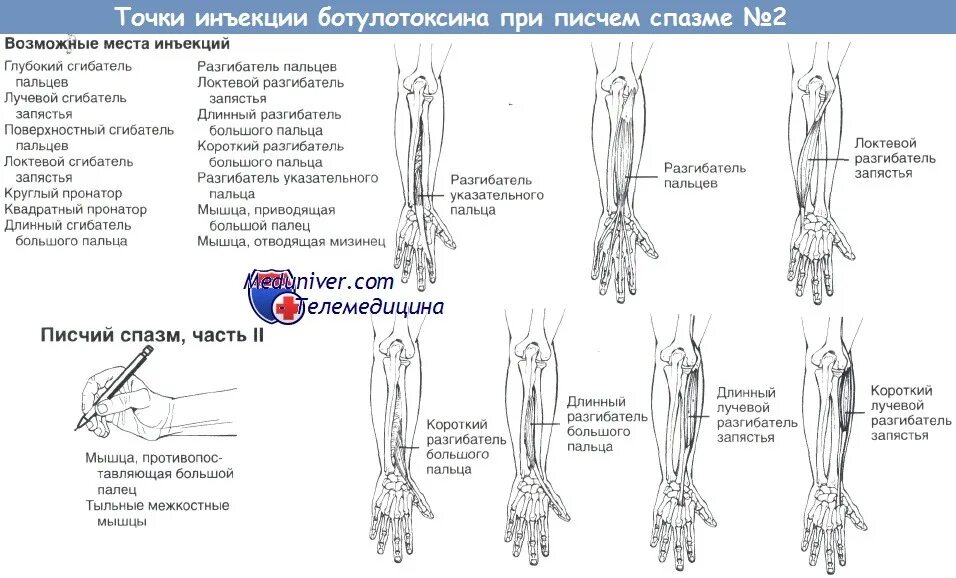 Точки уколов при ботулинотерапии. Ботулинотерапия схема мышц. Гимнастика при писчем спазме. Методика введения ботулотоксина в локтевой разгибатель запястья. Точка уколова