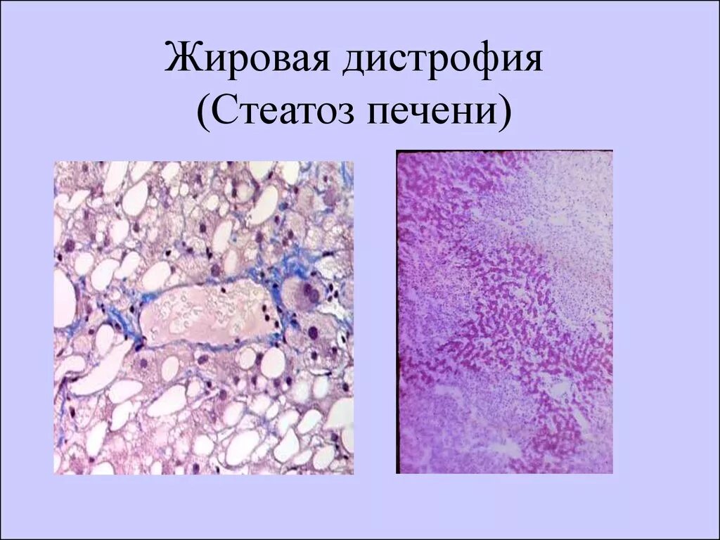 Дегенерация печени к 76.0. Клеточные жировые дистрофии. Жировая дистрофия кардиомиоцитов гистология. Жировая дистрофия (стеатоз) печени микропрепарат. Жировая дистрофия печечени.