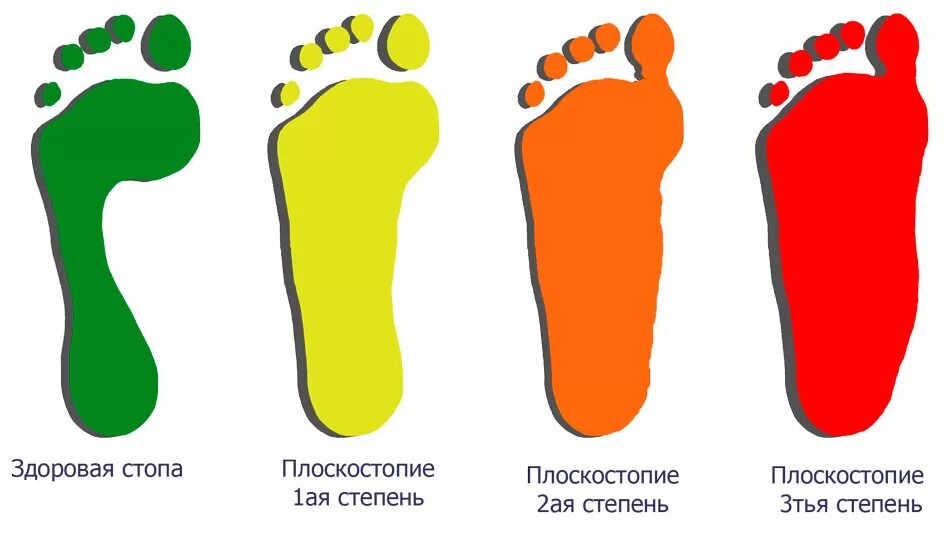 стопа 3 1 1. продольное и поперечное плоскостопие 1 и 2 степени. стопа 3 1 1. плоскостопие высота свода стопы. свод стопы плоскостопие.