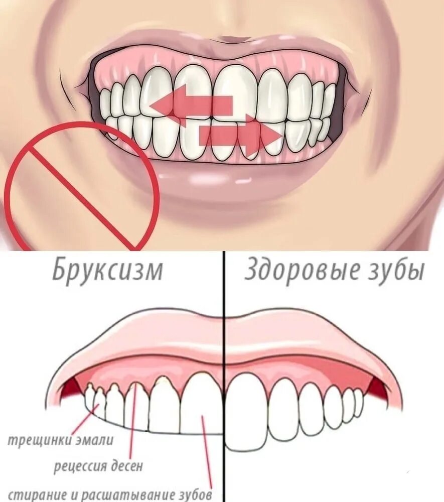 Почему сжимаются зубы. Стираемость зубов бруксизм. Бруксизм скрежетание зубами. Бруксизм стирание зубов.