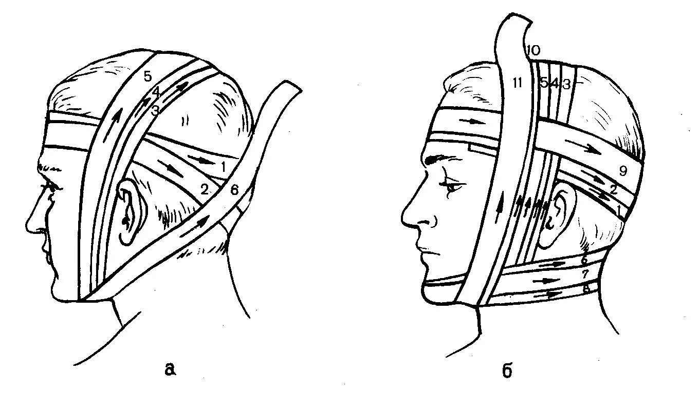 Как перевязывать голову. Наложение повязки на голову уздечка. Повязка уздечка техника наложения. Десмургия повязка уздечка. Технику наложения повязки «уздечка»..
