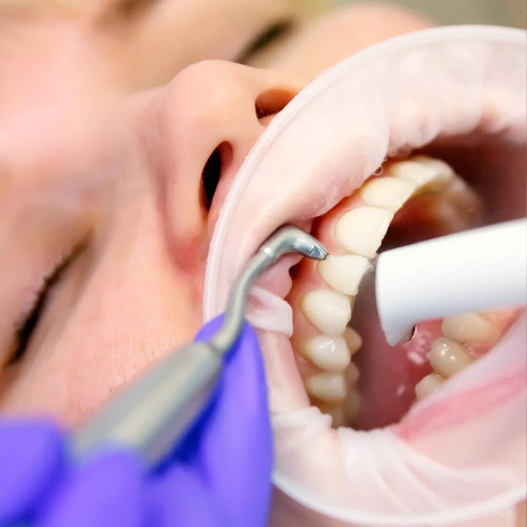 Аир флоу в стоматологии. Гпроф гигиена полости рта. Как чистят зубы ультразвуком. Ультразвуковая чистка зубов аппарат. Ультразвуковая чистка зубов.