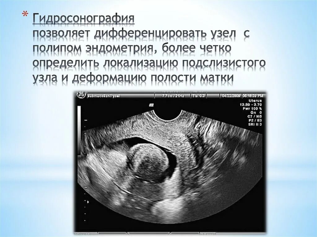 Полость матки деформирована. Полип эндометрия полости матки УЗИ. Эпидермизирующийся полип эндометрия. Гидросонография. Полип эндометрия в матке на УЗИ.