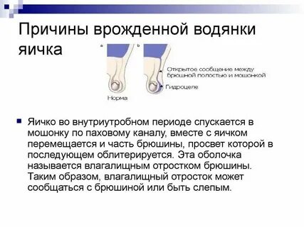 Водянка это