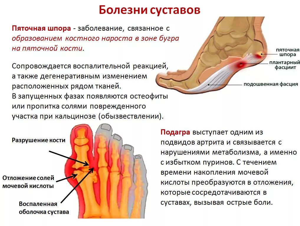 Лечение ноющей боли в ногах. Пяточная шпора симптомы.