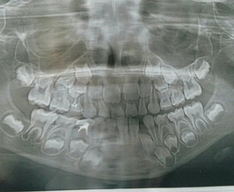 ортопантомограмма сменного прикуса. челюсть ребенка 3 года. рентген черепа с молочными зубами. рентген черепа ребенка с молочными зубами. сверхкомплектные зубы рентген.
