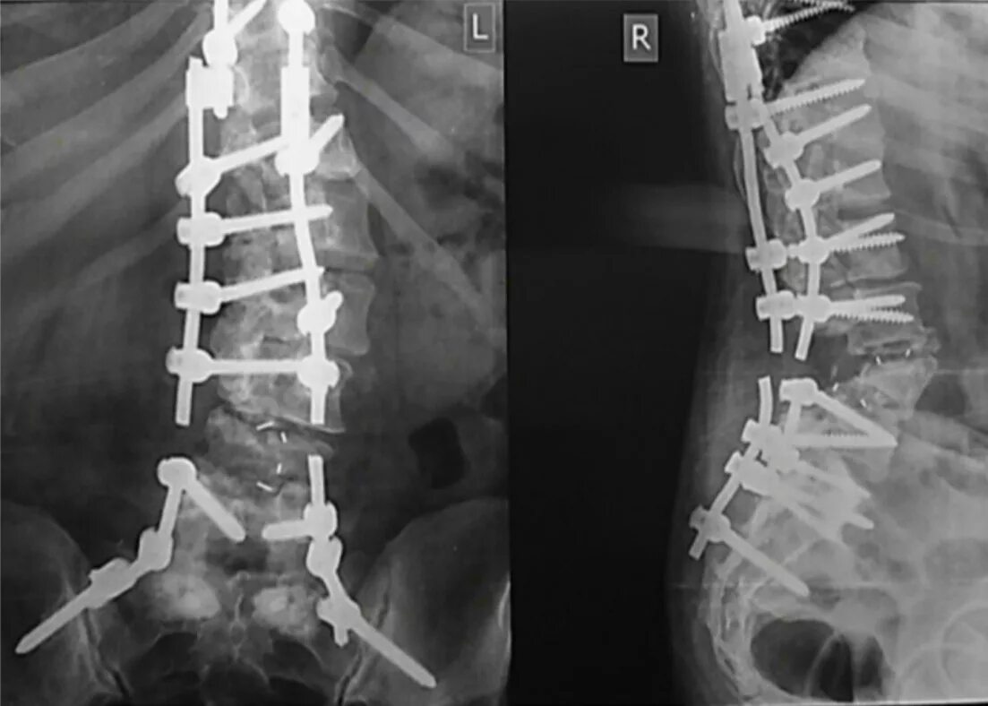 Спинальный стеноз операция. Перелом с1 позвонка рентген. Транспедикулярный остеосинтез l4-l5. Перелом позвоночника остеосинтез рентген. Компрессионный перелом шейного отдела позвоночника рентген.