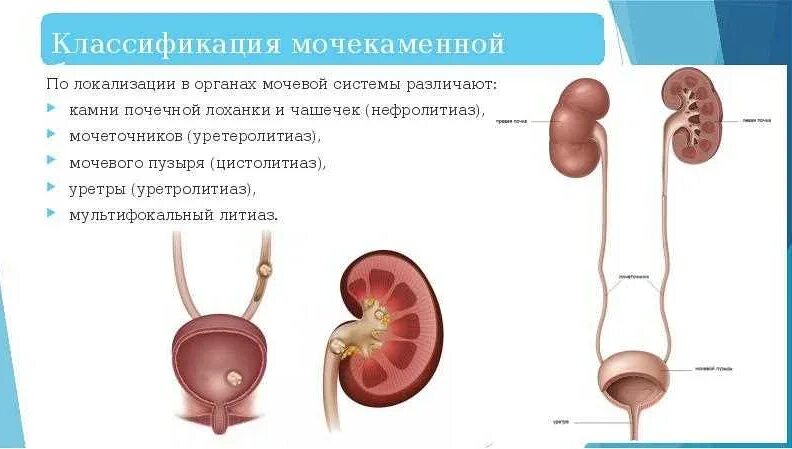 мочекаменная болезнь, или нефролитиаз. уратные камни. оксалаты кальция камни в почках. растворение почечных камней. камень в почке отзывы женщин.
