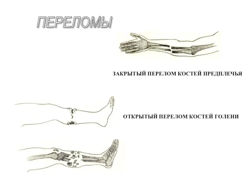 Открытый перелом кости руки. Перелом кости предплечья. Переломы костей закрытый открытый. Открытый перелом кости предплечья. Закрытый перелом кости предплечья.