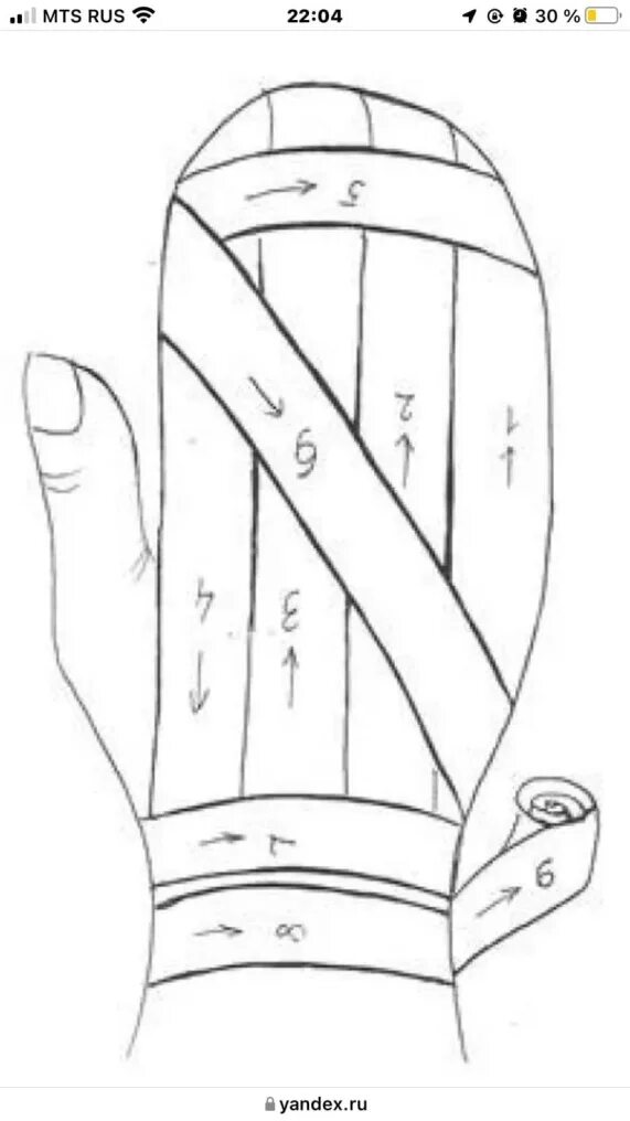 Техника наложения варежки. Наложение повязки варежка алгоритм. Технология наложения повязки варежка. Наложить повязку варежка алгоритм. Повязка варежка на кисть техника наложения.