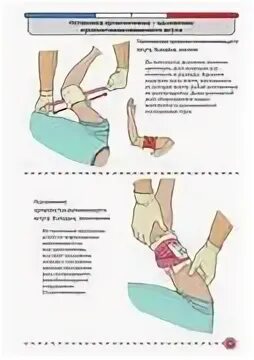 Наложение артериального жгута на нижнюю конечность. Жгут кровоостанавливающий Эсмарха. Наложение жгута Эсмарха при артериальном кровотечении. Наложение жгута Эсмарха при кровотечении алгоритм. При наложении жгута Эсмарха:.