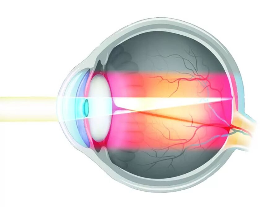 Физическая рефракция глаза. Нормальная рефракция глаза это. Миопическая рефракция глаза. Рефракция это в офтальмологии.