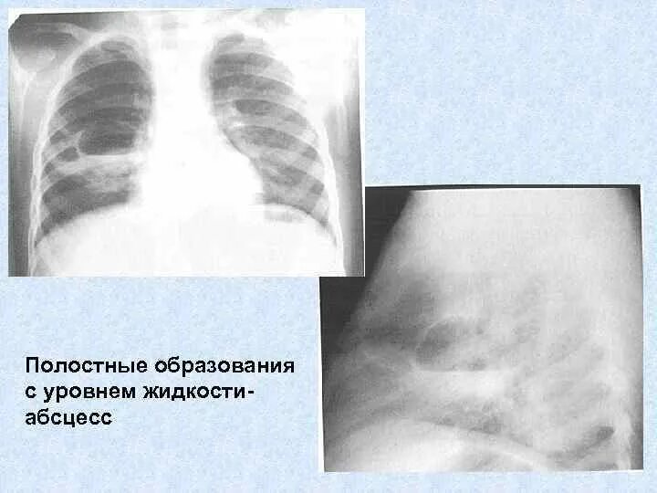 Образование полостей в легких