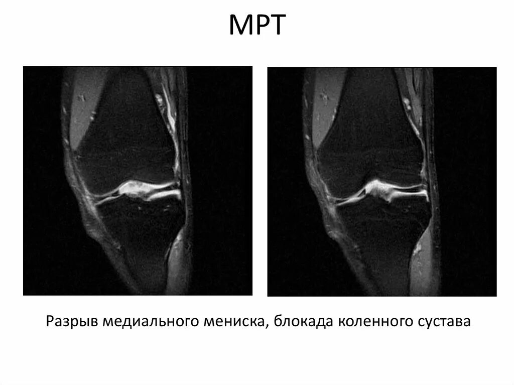 Повреждение мениска коленного сустава мрт. Снимок мрт коленного сустава с разрывом мениска.