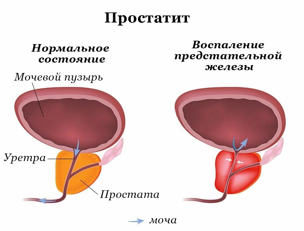 Воспалить простату. Воспаление мочевого пузыря. Воспалительные заболевания мочевого пузыря. Воспаление предстательной железы.