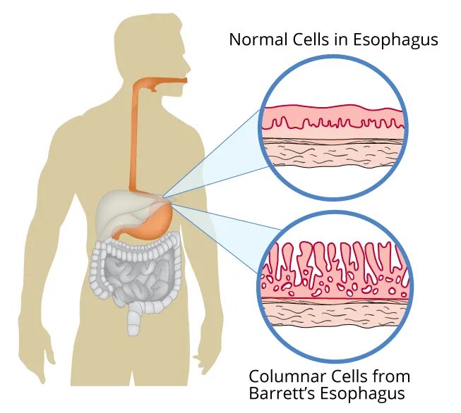 Пищевод Барретта патологическая анатомия. Баретта пищевод Барретта что это. Болезнь Баррета пищевод Барретта симптомы.
