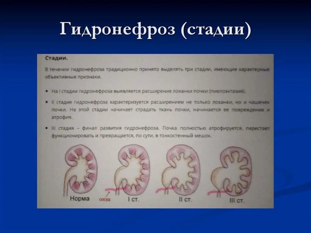 Гидронефроз почки классификация. УЗИ почек гидронефроз 1ст. Гидронефроз УЗИ классификация.