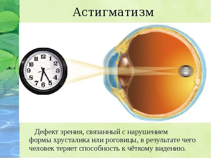 Дефекты зрения ответы. Близорукость дальнозоркость астигматизм. Дефекты зрения астигматизм. Дефекты зрения близорукость. Строение глаза дефекты зрения.