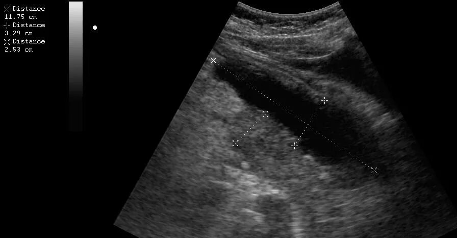 Острый панкреатит УЗИ картина. Эхосканирование поджелудочной железы. УЗИ поджелудочной железы. Острый панкреатит эхограммы. На узи видно поджелудочную железу