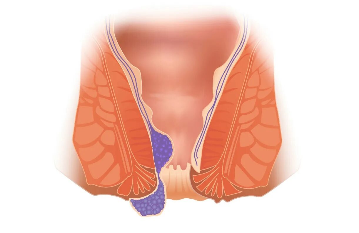 Чешется и зудит в заднем проходе. Зуд в прямой кишке причины. Хронический геморрой степени. Какие заболевания прямой кишки. Зуд в прямой кишке причины.