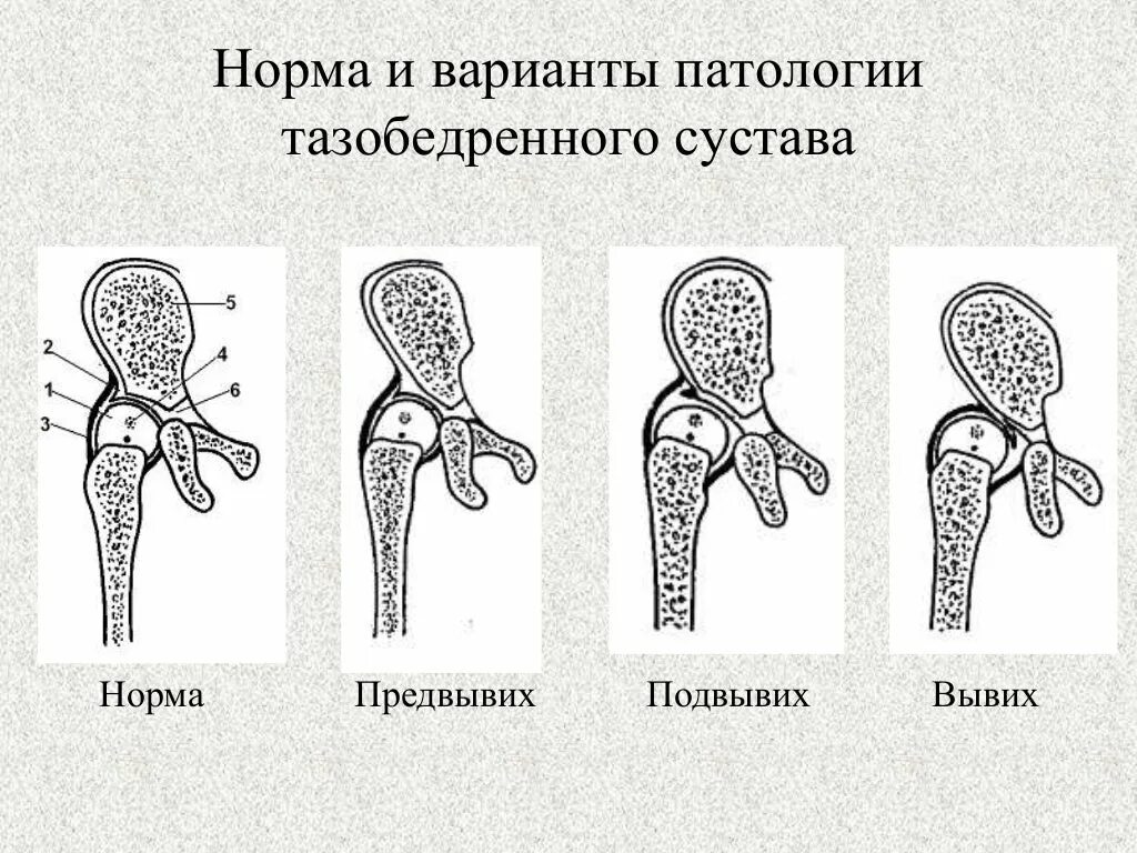 Подвывих тазобедренного сустава симптомы и лечение. Подвывих тазобедренного сустава. классификация вывихов бедренной кости. подвывих головки бедренной кости классификация. предвывих тазобедренного сустава.