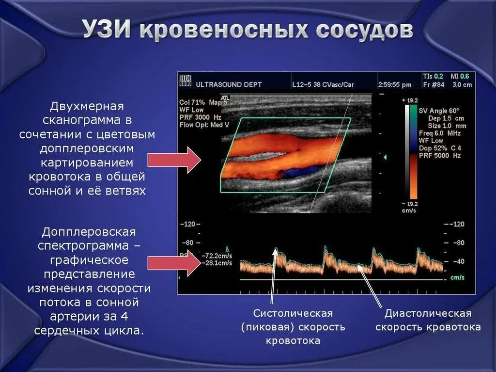 Диссекция позвоночной артерии на кт. Диссекция позвоночной артерии. Ультразвуковое допплеровское исследование. Узи уздг брахиоцефальных сосудов. Узи височных артерий.