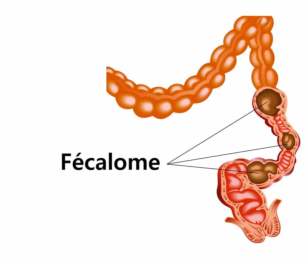Дефекация при запоре. Запор. Толстый кишечник запор. Что такое каловый застой кишечника.