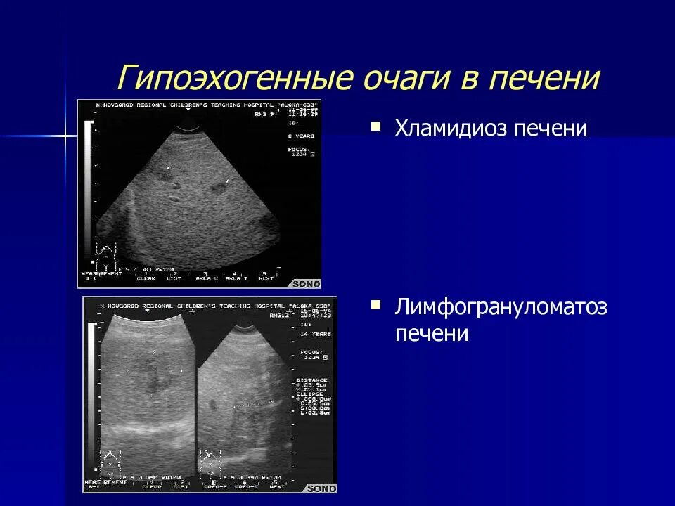 Очаговые поражения печени. Образования печени по УЗИ. Очаговые образования в печени на УЗИ. Гиперваскулярное образование печени