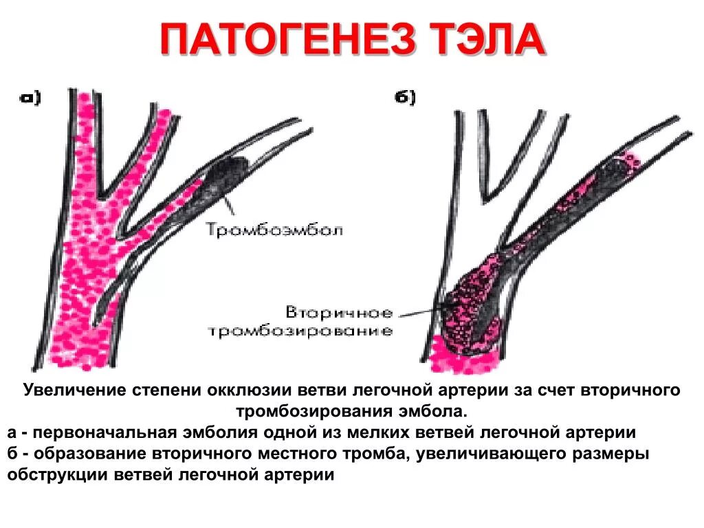 Тромбоэмболия ветвей легочной артерии. Тромбоэмболия легочной артерии этиология. Тэла патогенез. Тромбофлебит легочной артерии
