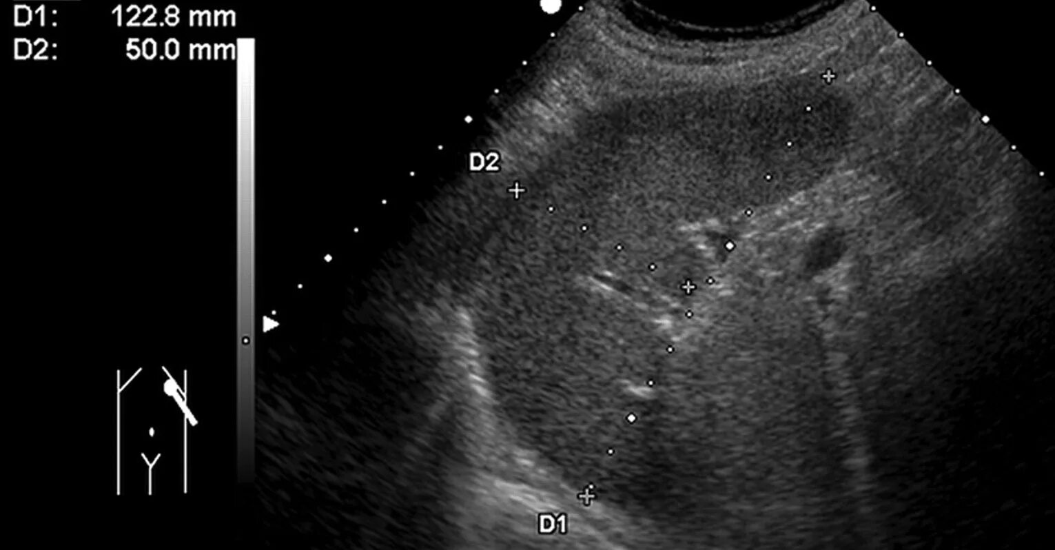 Какая норма селезенки. Миелолипома селезенки УЗИ. Патологии селезенки УЗИ норма. Гемангиосаркома селезенки УЗИ. Тератома селезенки УЗИ.