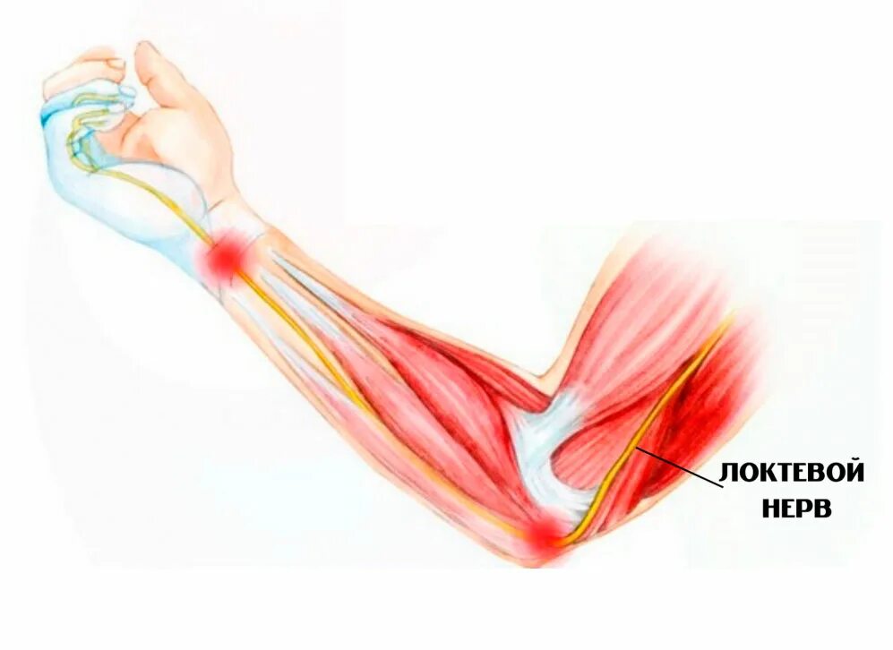 Повреждение локтевого нерва. Кубитальный канал локтевого сустава. Синдром кубитального канала. Локтевой нерв в кубитальном канале. Анатомия кубитального канала.