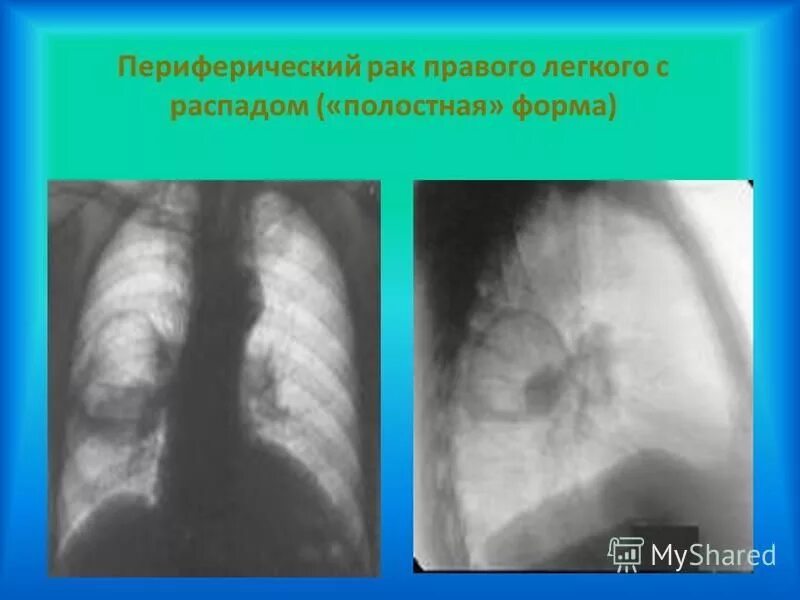 Периферическое образование в правом легком. Периферическое образование в правом легком. Рентгенодиагностика абсцесса легкого. Новообразование верхней доли правого легкого. Периферическое образование в правом легком.
