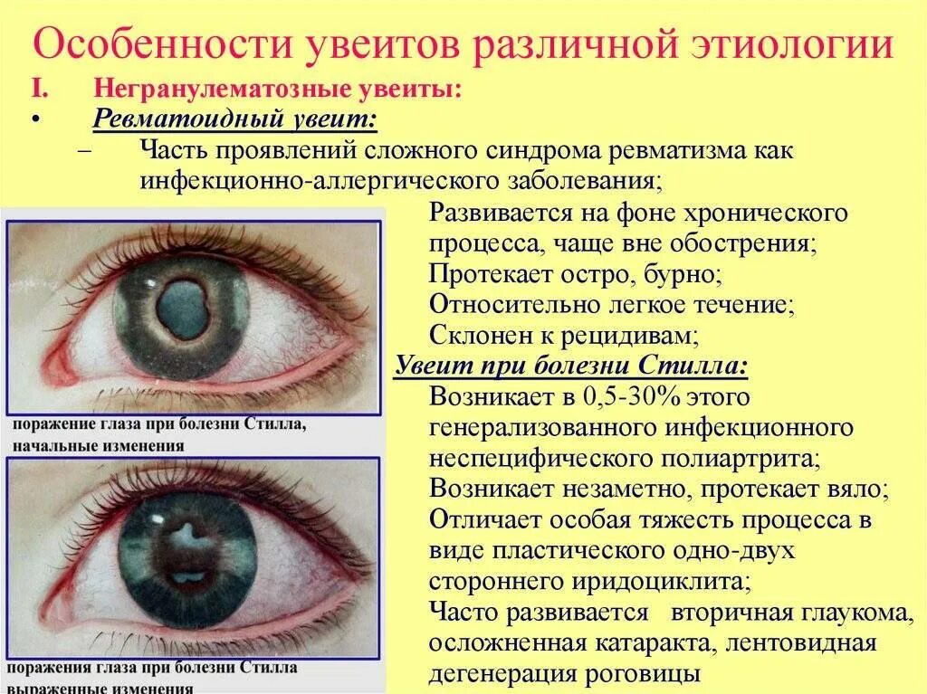 Признаки глазных болезней