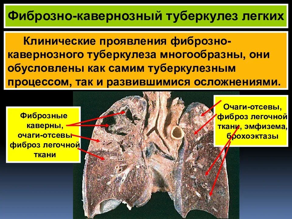 Как лечить фиброзные изменения