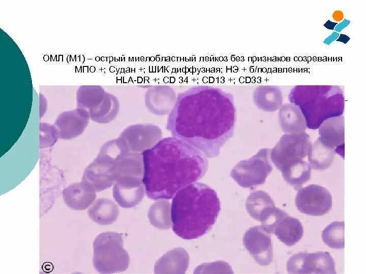 Острый миелоидный лейкоз прогноз. Острый миелобластный лейкоз м2. Острый миелобластный лейкоз симптомы. Острый монобластный лейкоз без созревания.