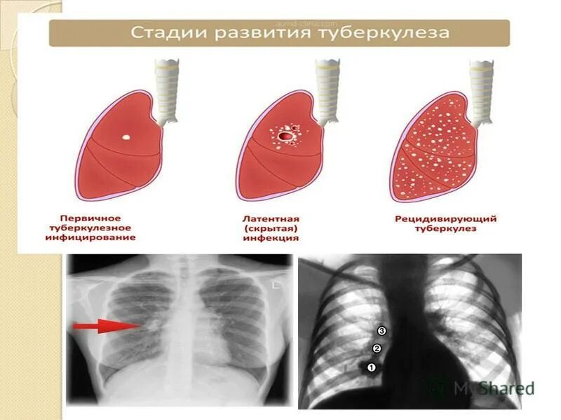 Начальная стадия туберкулеза у взрослых. Формы туберкулеза у взрослых. Тяжелая форма туберкулеза. Степени туберкулеза легких.