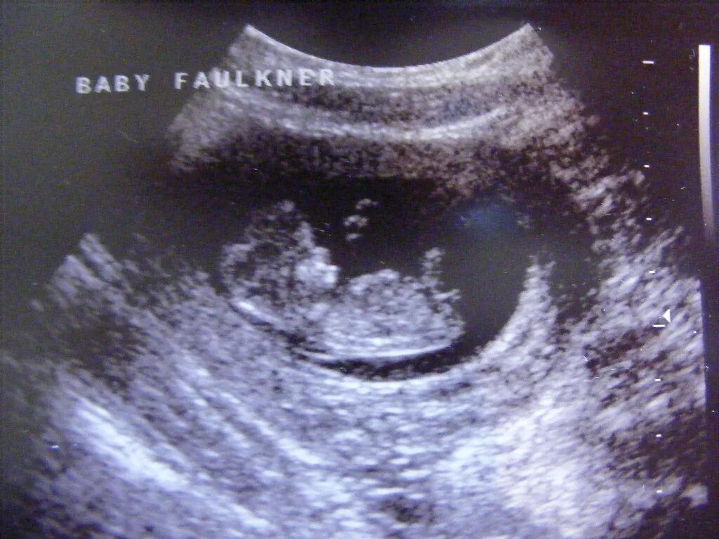 Ultrasound 11 weeks 3 days He or she was kicking a bit tod. Flickr
