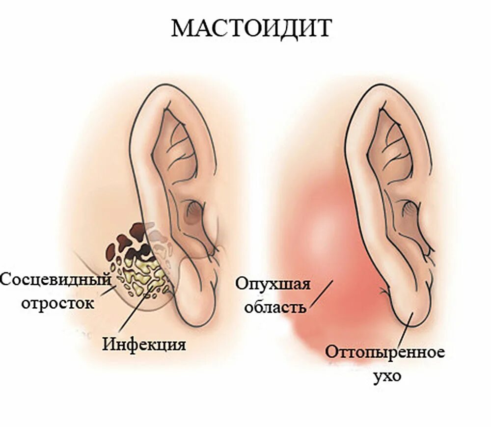 Воспаление сосцевидного отростка височной кости. Мастоидиты воспаление сосцевидного отростка. Воспаление ячеек сосцевидного отростка. Сосцевидный отросток отит среднего уха. Утолщение слизистой сосцевидного отростка