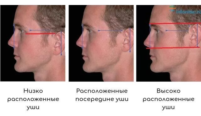 Уши выше глаз. Нищкорасполоденые уши. Высокое расположение ушей. Низко расположенные ушные раковины.