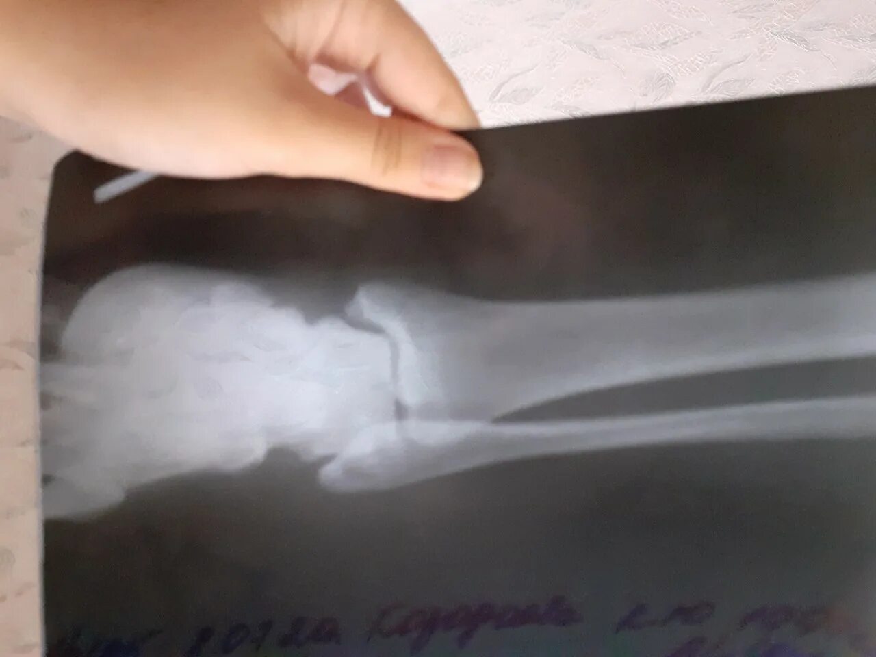 Перелом ноги голеностоп. Фиксатор сухожилия разгибателя пальца. Лангетка при переломе лодыжки со смещением. Исправление вальгусной деформации. Можно ли снимать лангетку на ночь.